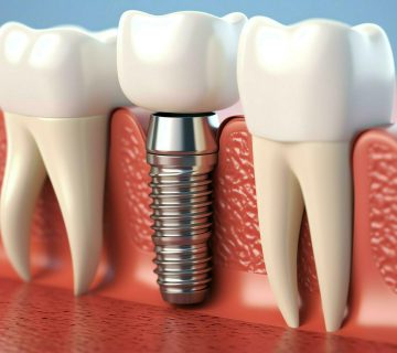 close up of a dental tooth implant or healthy human teeth white enamel and dental implants surgery concept by ai generated free photo