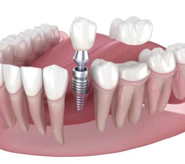 Dental implants vs veneers 1568x1045 1