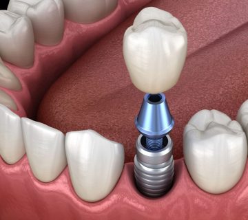 Understanding abutment and restoration placement for dental implants Excellence In Dentistry 1024x768 1