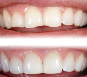 odontoiatria estetica faccette