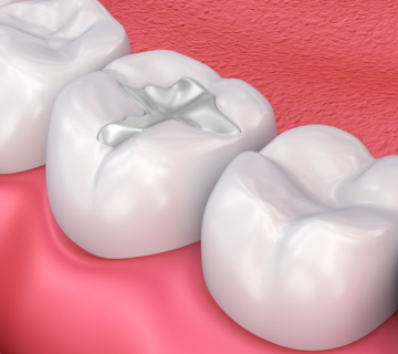 tooth coloured fillings benefits