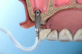 جراحی سینوس اُپن هر نیم فک GBR 1