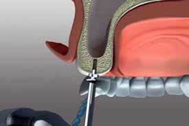 جراحی سینوس کلوز