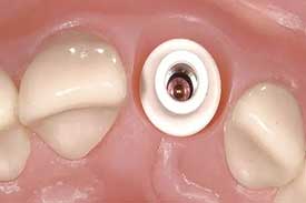 پین داخل کانال 1