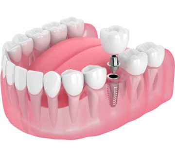 3d render of jaw with dental implant 1