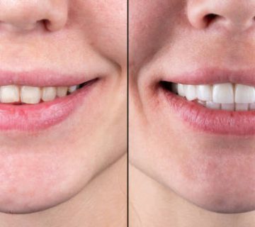 ceramic crowns and veneers before and after picture