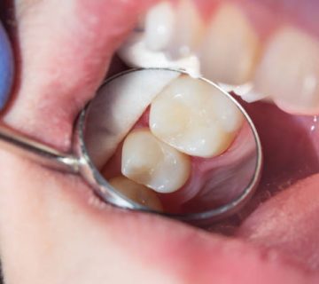 close up of a human rotten carious tooth at the treatment stage in a dental clinic