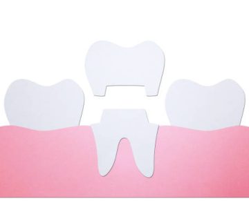 dental crown installation process and change of teeth