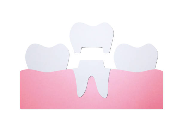 dental crown installation process and change of teeth
