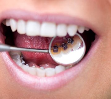 dental mirror showing lingual braces