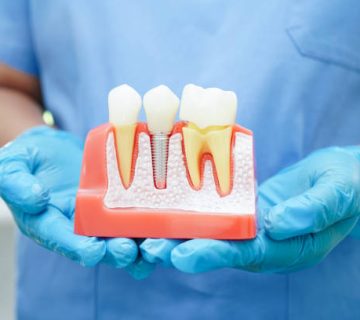 doctor hold dental implant artificial tooth roots into jaw root canal of dental treatment gum 1