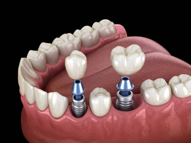 premolar and molar tooth crown installation over implant screw fixation 3d illustration of 3