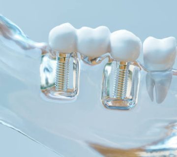 tooth human implant 3d rendering 1