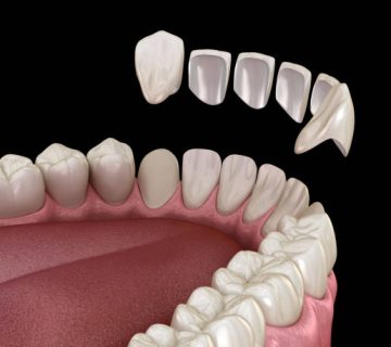 veneer installation procedure over central incisor and lateral incisors medically accurate
