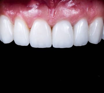 20 unit emax press ceramic veneers