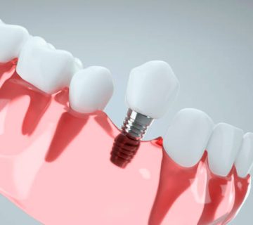 3d image of tooth implant going to jaw bone 2