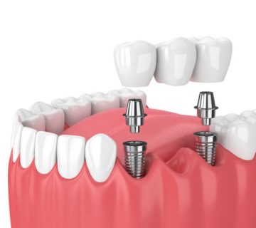 3d render of jaw and implants with dental bridge 1