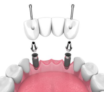 3d render of jaw with dental bridge supported by implants over white