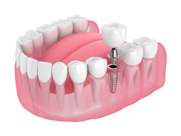 3d render of jaw with dental implant
