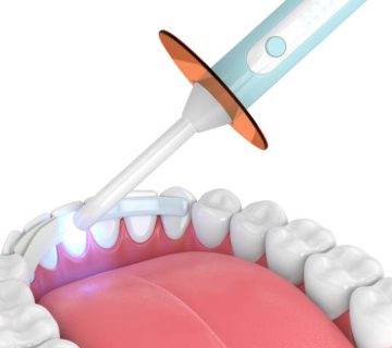 3d render of jaw with dental polymerization lamp and dental fiber