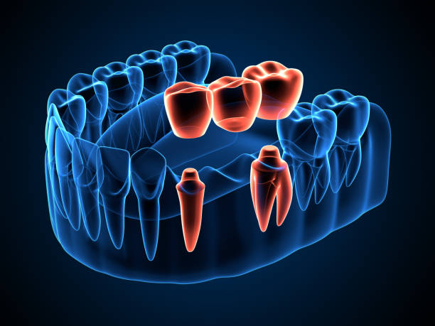 3d render of jaw x ray with dental bridge over molar and premolar teeth