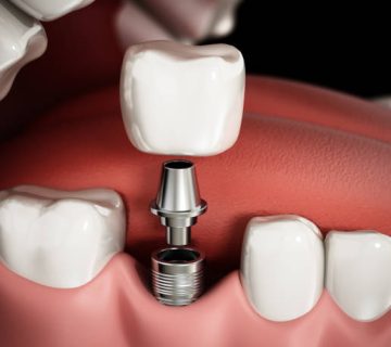 3d rendering representing the structure of dental implant procedure 2