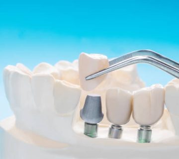 close up implant and prosthodontic 3