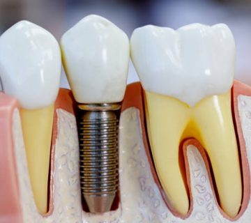 close up of dental model with implantation 2