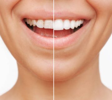 cropped shot of a young caucasian smiling woman before and after veneers installation 2
