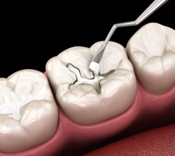 decayed tooth restoration with composite filling dental 3d illustration