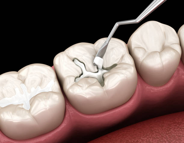 decayed tooth restoration with composite filling dental 3d illustration