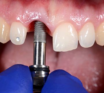 dental implant 3