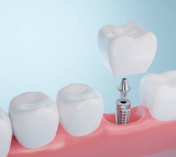 dental implant 4