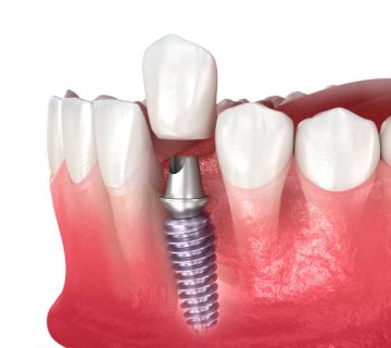 dental implant and ceramic crown medically accurate tooth 3d illustration 2