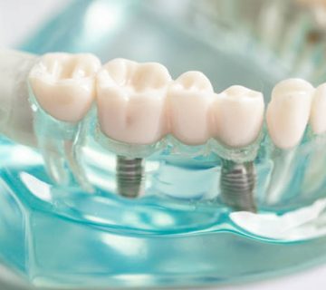 dental implant artificial tooth roots into jaw root canal of dental treatment gum disease