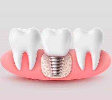dental implantation tooth restoration symbol on a white background vector illustration