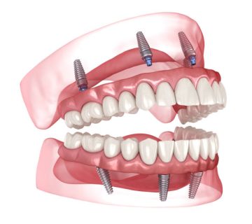 dental prosthesis based on 4 implants dental 3d illustration 1