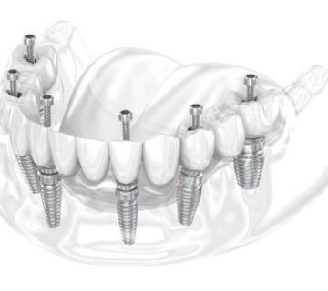 dental prosthesis supported by six implants dental 3d illustration