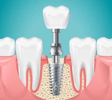 dental surgery tooth implant cut vector illustration healthy teeth and dental implant