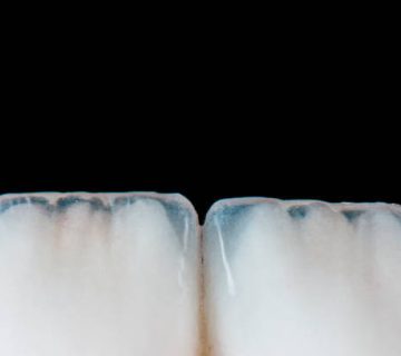 dental treatment case by ceramic crowns and veneers