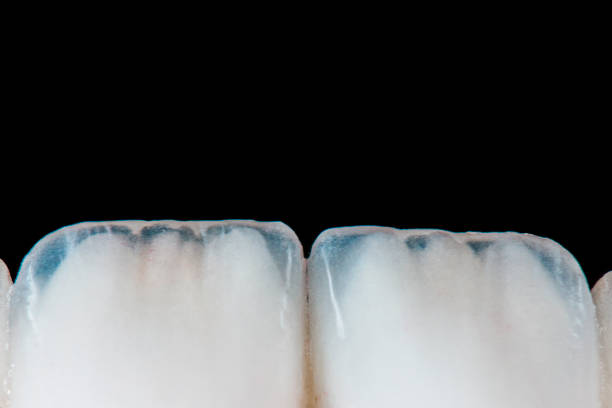 dental treatment case by ceramic crowns and veneers