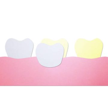 dental veneers putting new veneers on discolored tooth