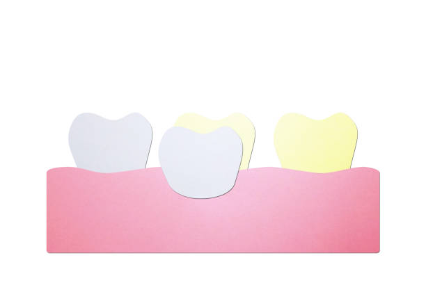 dental veneers putting new veneers on discolored tooth