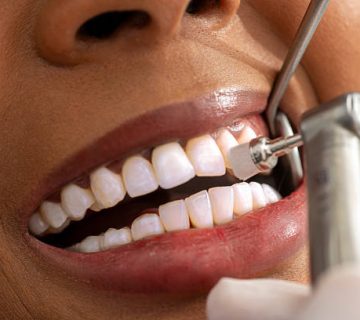dentist polishing teeth of patient in dental clinic
