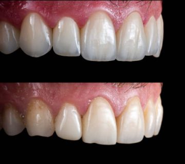 emax ceramic crowns and veneers like natural teeth