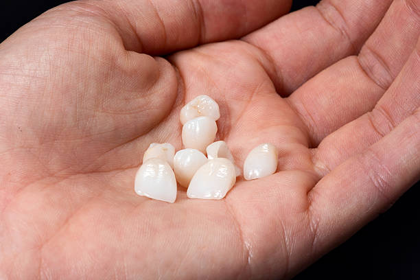 hand with dental veneers