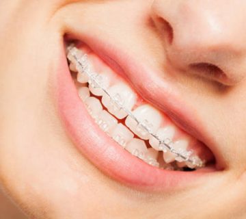 happy smile of young woman with dental braces
