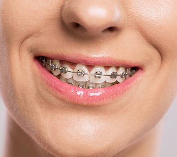 healthy smile with braces 2