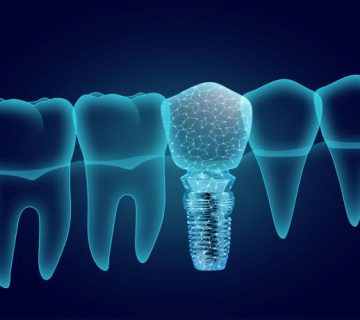 illustration of teeth and dental implant on dark blue background 1