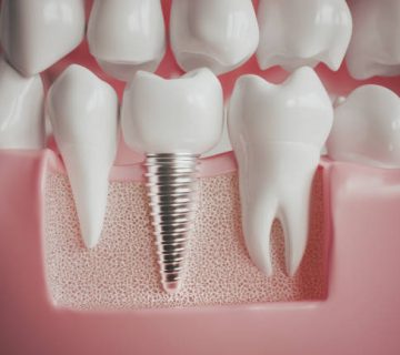 implant next to a healthy molar 3d rendering